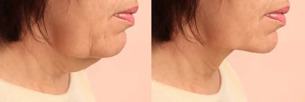 双下巴问题 在米色背景 特写的皮肤紧致治疗前后与成熟女性合影的拼贴 — 图库照片