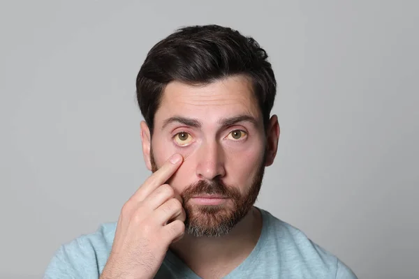Άνθρωπος Κίτρινα Μάτια Γκρι Φόντο Συμπτώματα Ηπατίτιδας — Φωτογραφία Αρχείου