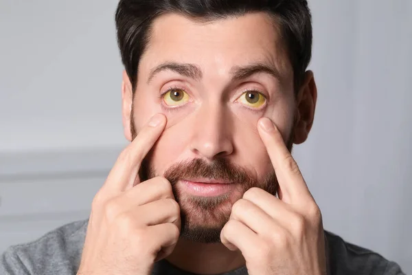 Mann Mit Gelben Augen Auf Verschwommenem Hintergrund Nahaufnahme Symptom Einer — Stockfoto