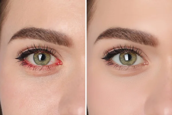 结膜炎治疗前后 感染近视和健康眼部的妇女合影 — 图库照片