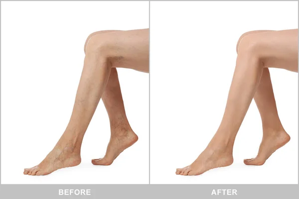 Przed Leczeniu Żylaków Kolaż Zdjęciami Kobiety Pokazującej Nogi Białym Tle — Zdjęcie stockowe