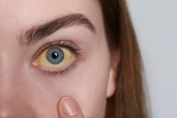 白い背景に黄色の目をした女性 クローズアップ 肝炎の症状 — ストック写真