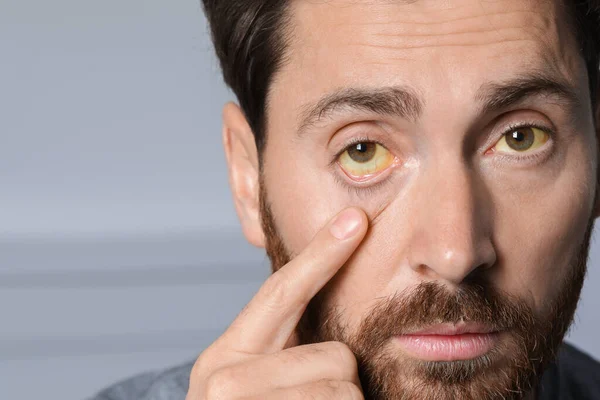 Man Yellow Eyes Blurred Background Closeup Symptom Hepatitis — Stock Photo, Image