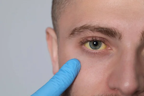Lekarz Sprawdza Żółte Oczy Pacjenta Jasnoszarym Tle Zbliżeniu Miejscu Tekst — Zdjęcie stockowe