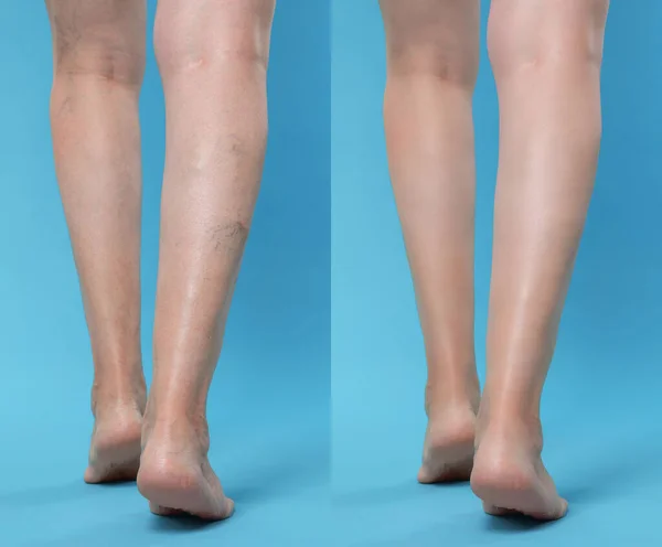 Varis Tedavisinden Önce Sonra Açık Mavi Arkaplanda Bacaklarını Gösteren Kadınların — Stok fotoğraf