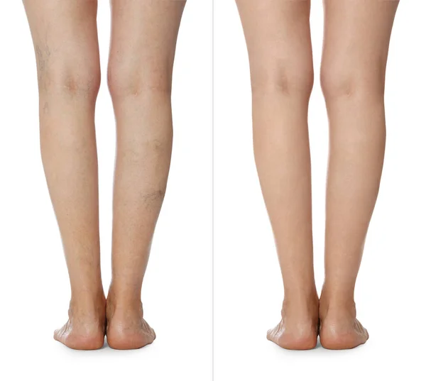 Varicose Veins Treatment Collage Photos Woman Showing Legs White Background — Stock Photo, Image