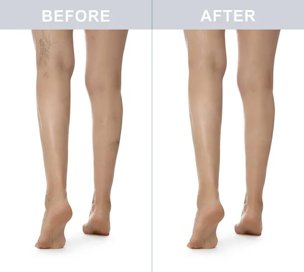 Przed Leczeniu Żylaków Kolaż Zdjęciami Kobiety Pokazującej Nogi Białym Tle — Zdjęcie stockowe