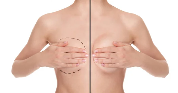 シリコンインプラントで乳房増強 整形前と後で二分された女性の写真白地にコラージュ — ストック写真