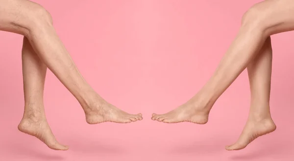 Przed Leczeniu Żylaków Kolaż Zdjęciami Kobiety Pokazującej Nogi Różowym Tle — Zdjęcie stockowe