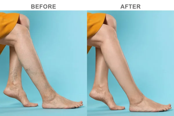 Przed Leczeniu Żylaków Kolaż Zdjęciami Kobiety Pokazującej Nogi Jasnoniebieskim Tle — Zdjęcie stockowe
