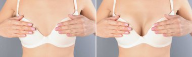 Göğüs büyütme ve silikon implantları. Gri arka planda estetik ameliyat öncesi ve sonrası kadın fotoğraflarıyla kolaj, yakın plan