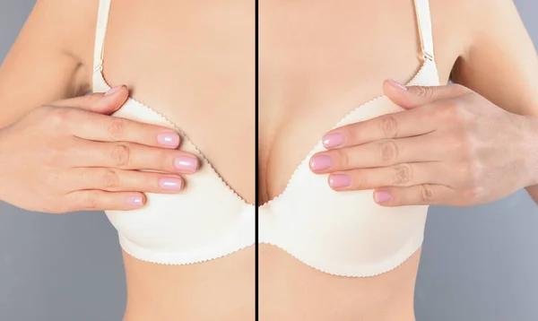 用硅酮植入物隆乳 整形手术前后分割成两半的女性照片 灰色背景的拼贴 — 图库照片