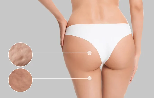 stock image Cellulite problem. Slim woman in underwear on light grey background, closeup. Zoomed skin areas with orange peel syndrome