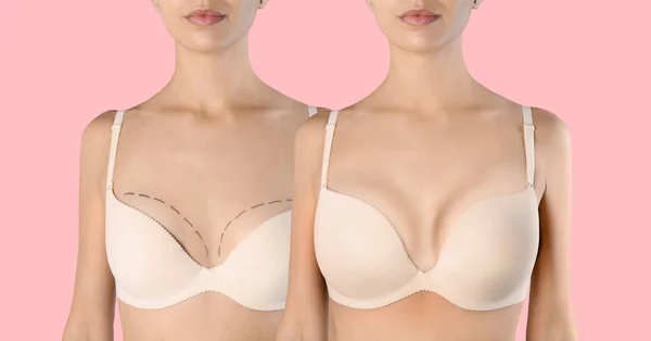 Collage Of Young Woman In Bra With Different Sizes Of Breast On White  Background. Plastic Surgery Concept Stock Photo, Picture and Royalty Free  Image. Image 162471190.