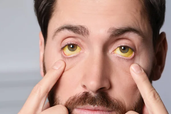 Άνθρωπος Κίτρινα Μάτια Θολή Φόντο Κοντινό Πλάνο Συμπτώματα Ηπατίτιδας — Φωτογραφία Αρχείου