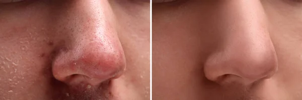 Fotos Von Menschen Vor Und Nach Der Akne Behandlung Nahaufnahme — Stockfoto