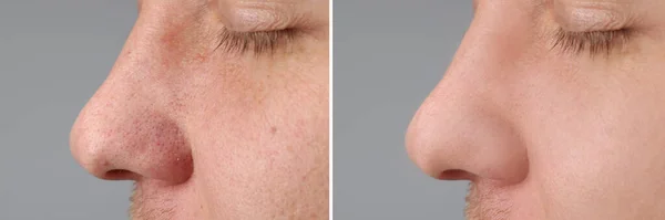 Before and after acne treatment. Photos of man on grey background, closeup. Collage showing affected and healthy skin