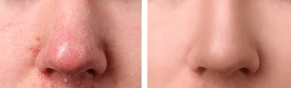 Fotos Von Menschen Vor Und Nach Der Akne Behandlung Nahaufnahme — Stockfoto