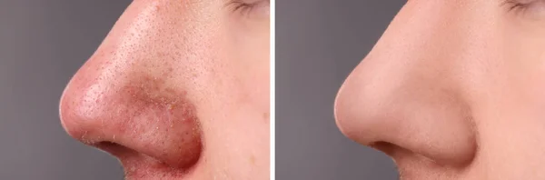 Vor Und Nach Der Akne Behandlung Fotos Von Menschen Auf — Stockfoto
