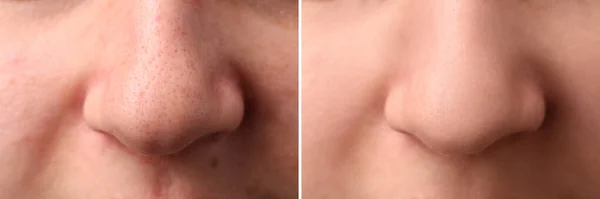 Fotos Von Frauen Vor Und Nach Der Akne Behandlung Nahaufnahme — Stockfoto