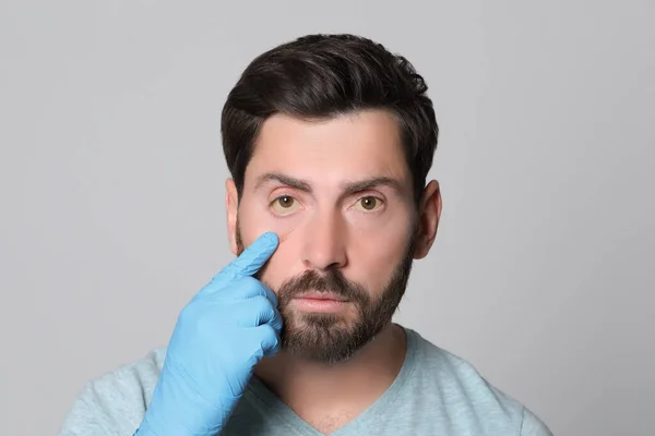 Доктор Проверяет Человека Желтыми Глазами Сером Фоне Симптом Гепатита — стоковое фото