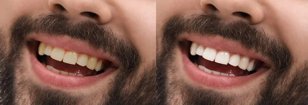 Koláž Fotografiemi Člověka Před Bělení Zubů Detailní Záběr — Stock fotografie