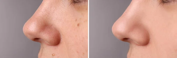 Vor Und Nach Der Akne Behandlung Fotos Von Frauen Auf — Stockfoto