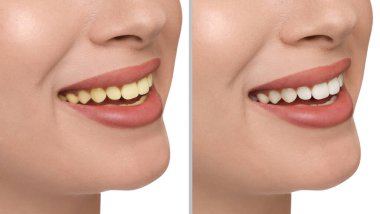 Beyaz arka planda diş beyazlatma öncesi ve sonrası kadın fotoğraflarıyla kolaj, yakın plan