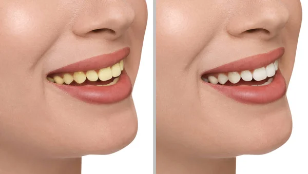 Коллаж Фотографиями Женщины После Отбеливания Зубов Белом Фоне Крупным Планом — стоковое фото