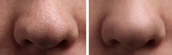 Foto Van Mens Voor Acne Behandeling Close Collage Met Aangetaste — Stockfoto