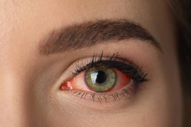 Woman suffering from conjunctivitis, closeup of red eye clipart