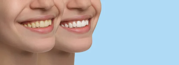 Kolaż Zdjęciami Kobiety Przed Wybielaniu Zębów Jasnoniebieskim Tle Zbliżenie Projekt — Zdjęcie stockowe