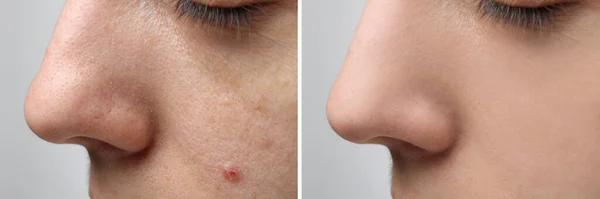 痤疮治疗前后 照片上女人的浅灰背景 显示受影响及健康皮肤的胶合物 — 图库照片