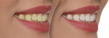 Diş beyazlatma öncesi ve sonrası kadın fotoğraflarıyla kolaj, yakın plan