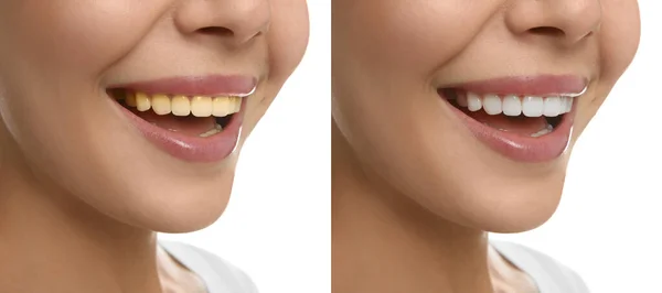 Колаж Фотографіями Жінки Після Відбілювання Зуба Білому Тлі Крупним Планом — стокове фото