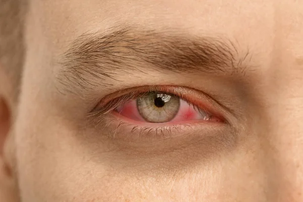 Mężczyzna Cierpiący Zapalenie Spojówek Zbliżenie Czerwonego Oka — Zdjęcie stockowe