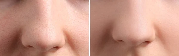 Foto Wanita Sebelum Dan Sesudah Perawatan Jerawat Closeup Kolase Menunjukkan — Stok Foto