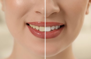 Kadın fotoğrafı, diş beyazlatmadan önce ve sonra ikiye bölünmüş, yakın plan. Kolaj tasarımı