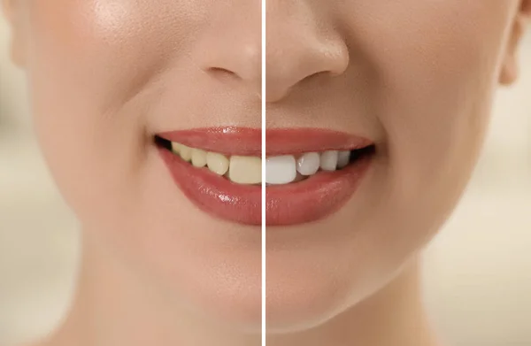 Zdjęcie Kobiety Podzielonej Połówki Przed Wybielaniu Zębów Zbliżenie Projekt Kolażu — Zdjęcie stockowe