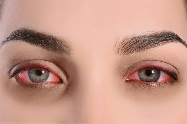 Kobieta Czerwonymi Oczami Cierpiąca Zapalenie Spojówek Zbliżenie — Zdjęcie stockowe