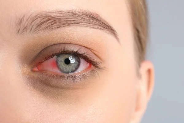 Kobieta Cierpiąca Zapalenie Spojówek Szarym Tle Zbliżenie Czerwonego Oka — Zdjęcie stockowe