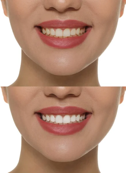 Κολάζ Φωτογραφίες Της Γυναίκας Πριν Και Μετά Λεύκανση Δοντιών Λευκό — Φωτογραφία Αρχείου