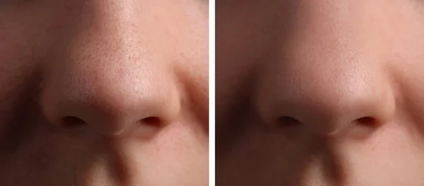 Fotos Von Frauen Vor Und Nach Der Akne Behandlung Nahaufnahme — Stockfoto