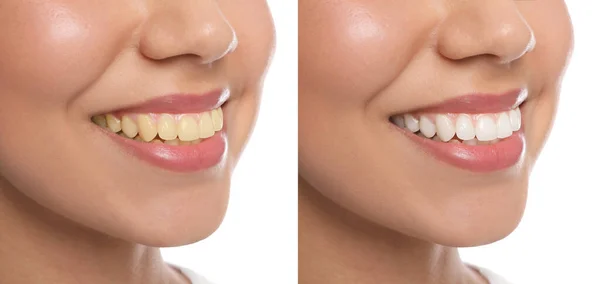 Kolaż Zdjęciami Kobiety Przed Wybielaniu Zębów Białym Tle Zbliżenie — Zdjęcie stockowe