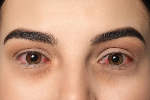 結膜炎に苦しんで赤い目をした女性を閉じます — ストック写真