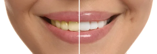 Zdjęcie Kobiety Podzielonej Połówki Przed Wybielaniu Zębów Białym Tle Zbliżenie — Zdjęcie stockowe