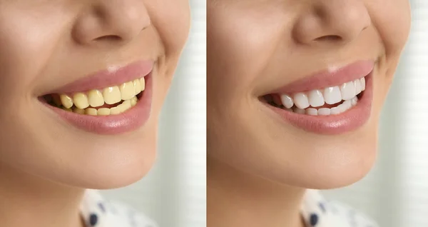 Diş Beyazlatma Öncesi Sonrası Kadın Fotoğraflarıyla Kolaj Yakın Plan — Stok fotoğraf