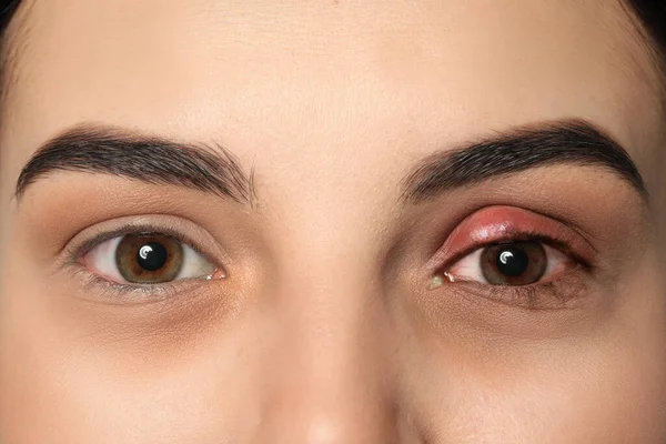 結膜炎に苦しんで目を炎症を起こした女性 クローズアップ — ストック写真
