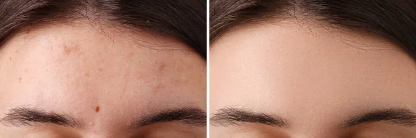 Collage Photos Woman Acne Problem Treatment Closeup Banner Design — Stock Photo, Image