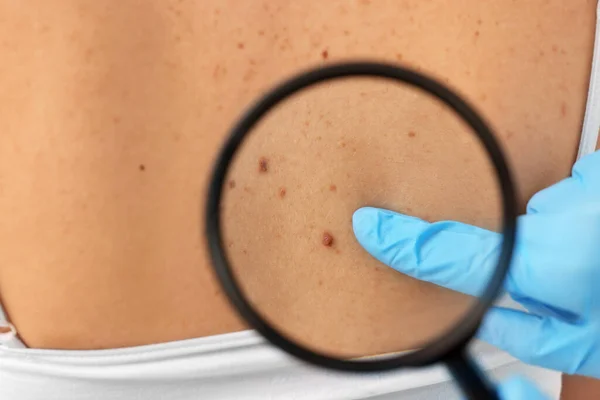 stock image Dermatologist examining patient's birthmark with magnifying glass, closeup